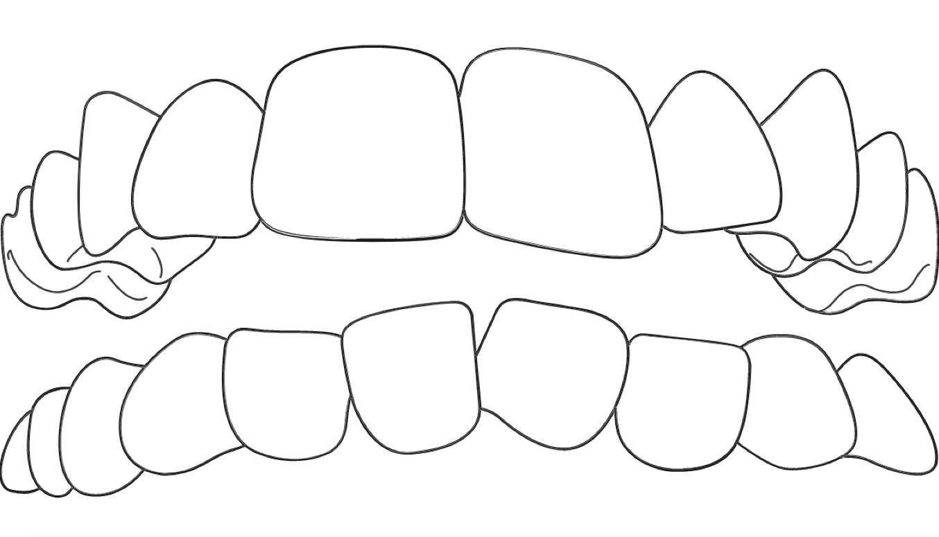Corrección de apiñamiento con Invisalign