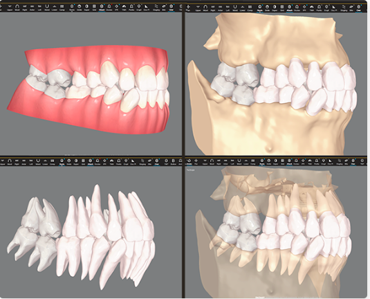 CBCT-Invisalign.png