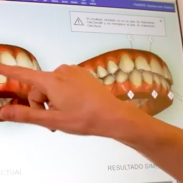 La Era iTero de Invisalign: Escaneo 3D para una Sonrisa Top