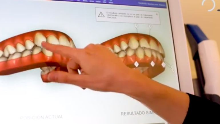La Era iTero de Invisalign: Escaneo 3D para una Sonrisa Top