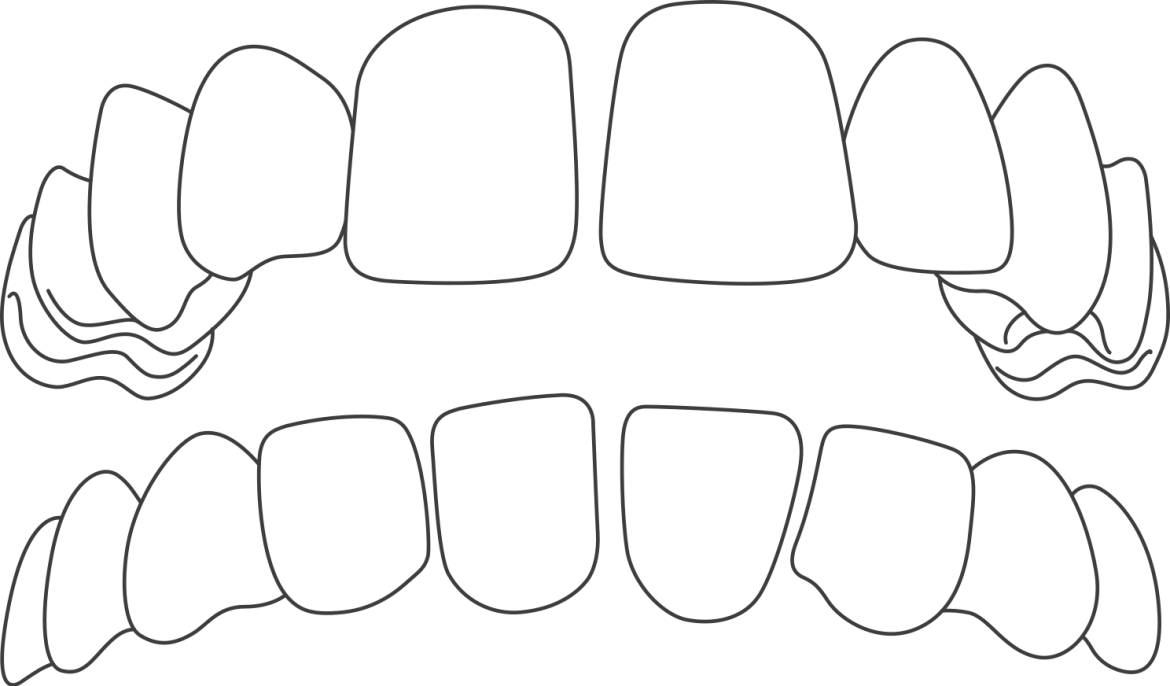 Dientes-Separados-1.webp