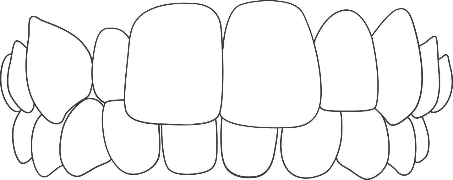 Corrección de mordida cruzada con Invisalign