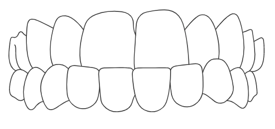prognatismo-1.webp
