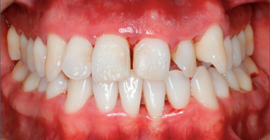Caso Diastema Antes