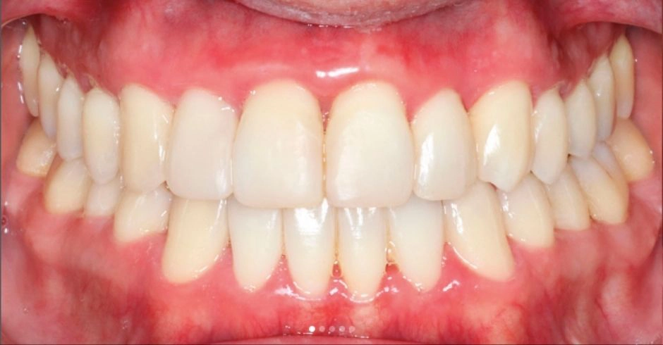 Caso Diastema Después con Invisalign