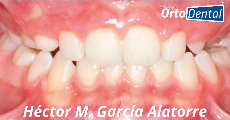 Caso Mordida Cruzada Después con Invisalign
