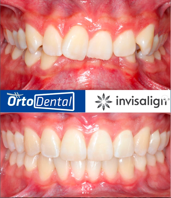 SOBREMORDIDA-Caso-1-1-Invisalign-Page.webp