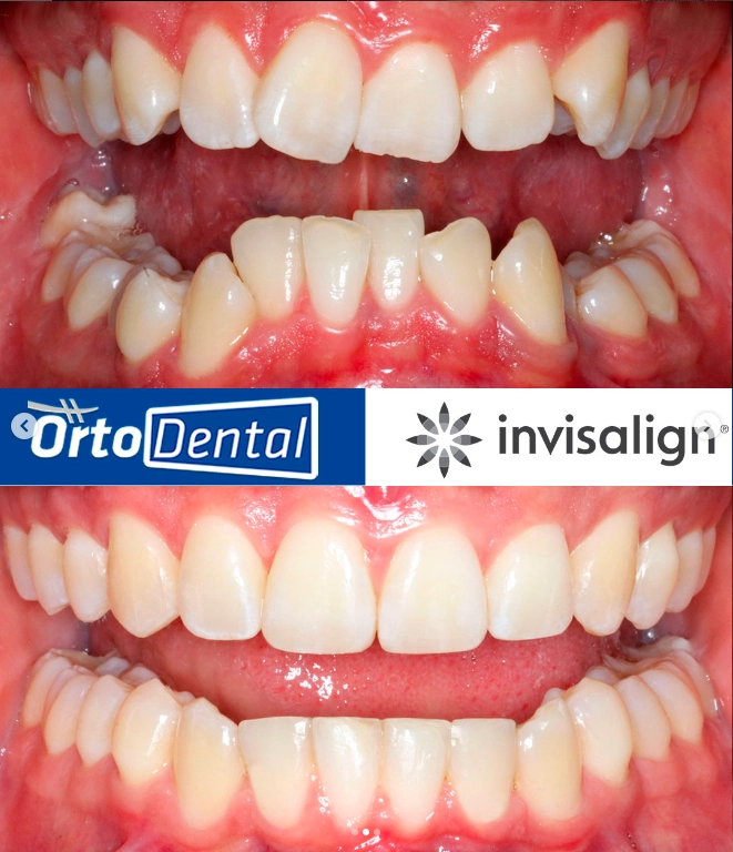 SOBREMORDIDA-Caso-1-2-Invisalign-Page.webp