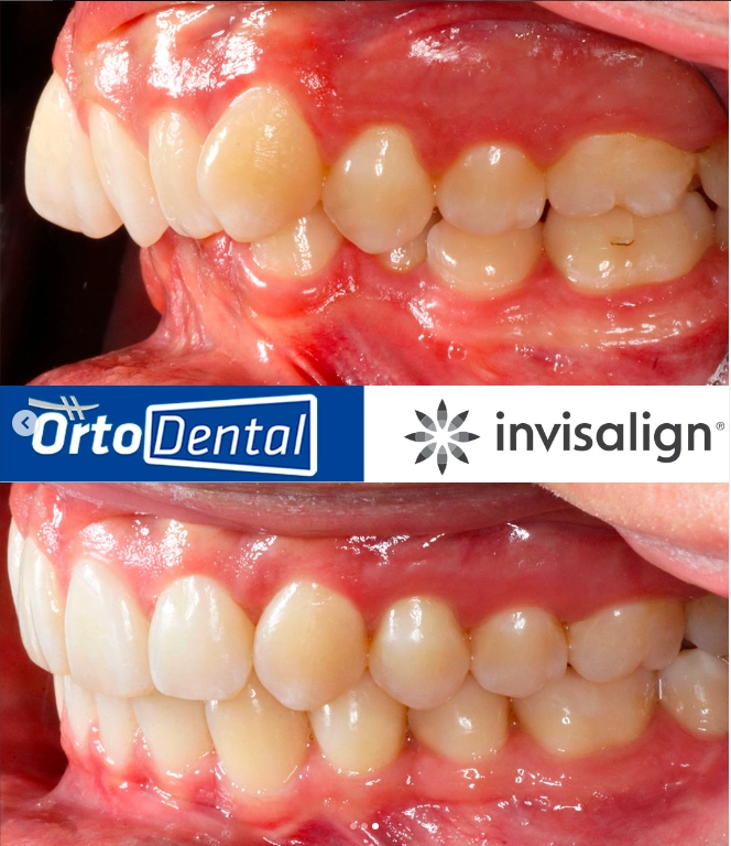 SOBREMORDIDA-Caso-1-3-Invisalign-Page.webp