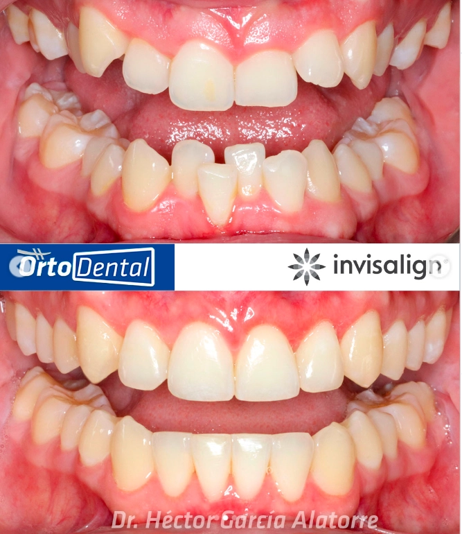 SOBREMORDIDA-Caso-2-1-Invisalign-Page.webp