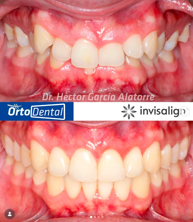 SOBREMORDIDA-Caso-2-2-Invisalign-Page.webp