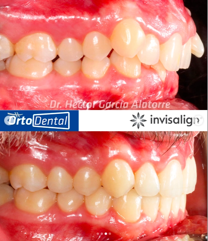 SOBREMORDIDA-Caso-2-3-Invisalign-Page.webp