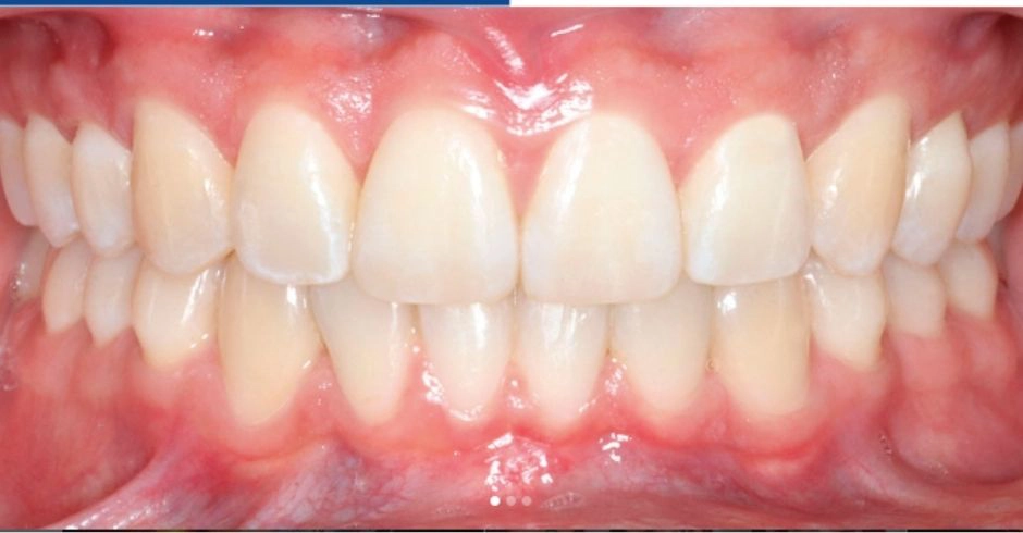 Caso de Sobremordida Después con Invisalign